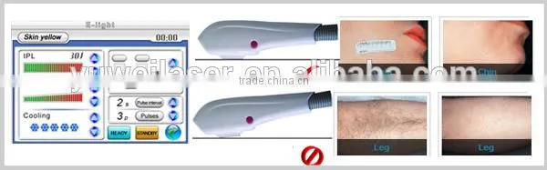 ipl rf hair removal play of light laser