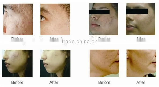 Diamond Dermabrasion beauty device for face lift with 2 in 1
