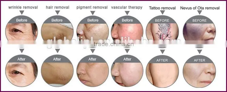Upgradeable system beauty ipl+elight+rf+yag laser hair removal laser machine