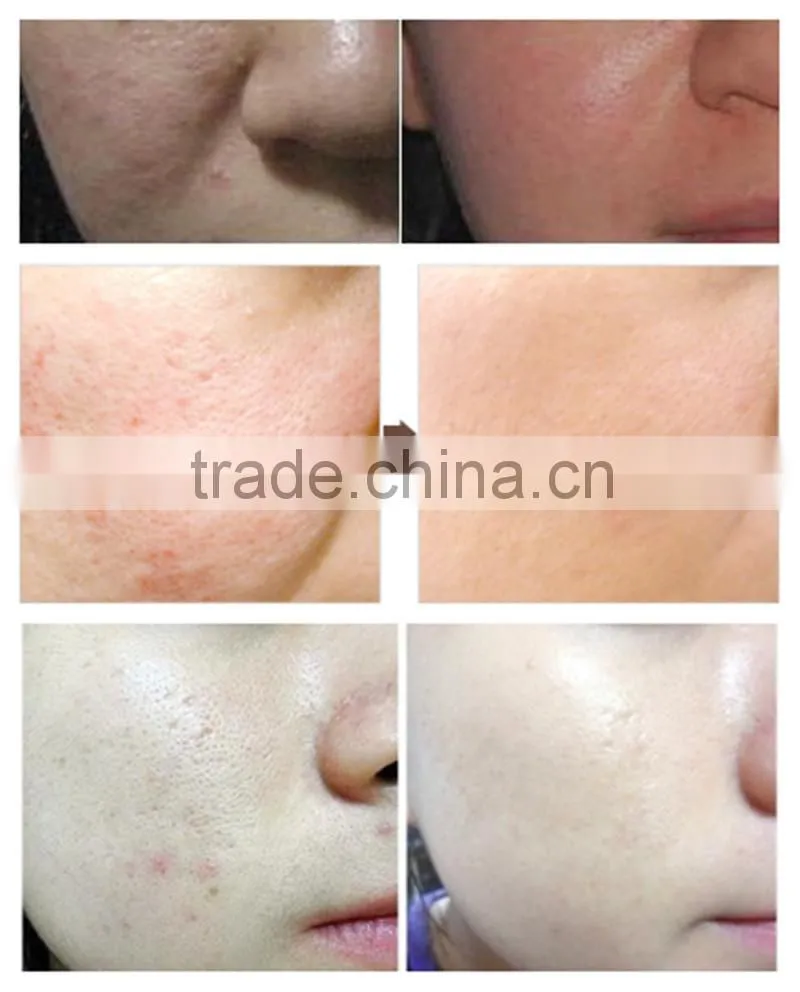 Facial led personal massager led light therapy for hair New light therapy