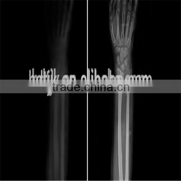 medical polymer fiberglass splint