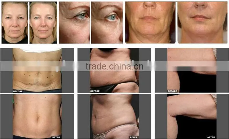 Best rf skin tightening face lifting machine&newest skin lifting machine