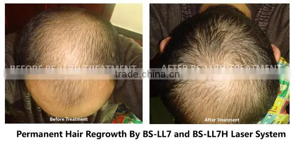 Laser Hair Treatment Machine for Hair Loss Treatment Hair Regrowth Equipment