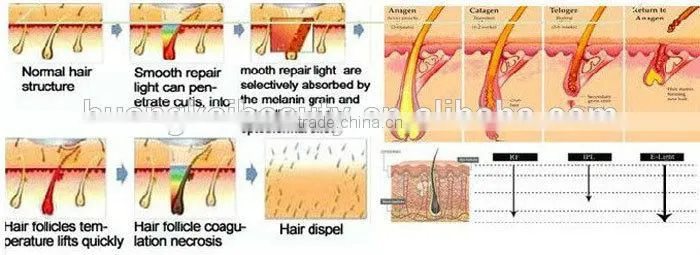 permanent hair removal for men