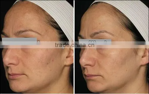 2016 Personal use 1064 long pulsed nd yag laser hair removal machine