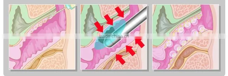 portable women sex hifu vaginal tightening machine with 10000shots