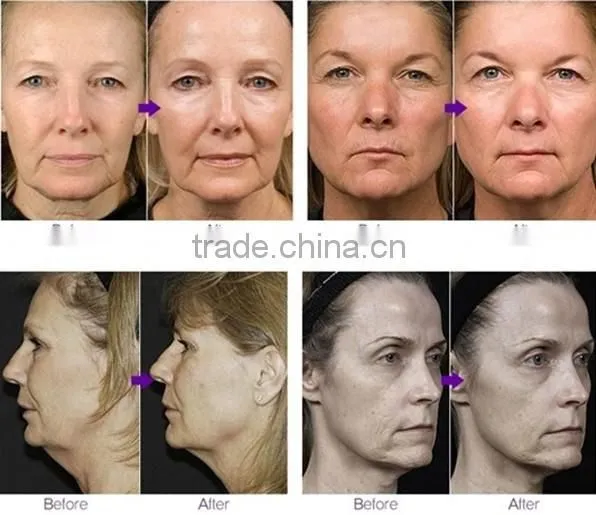 2015 Hot New Fractional RF Micro Needle Facial Machine/ Home Infrared Skin Tightening Machine