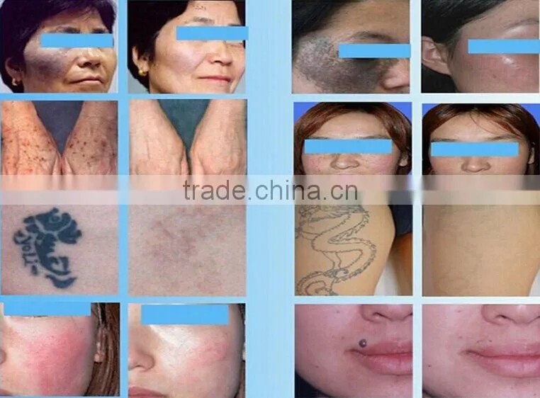 Q-switch Nd Yag Laser Skin Rejuvenation tatoo removal machine with CE from Sanhe