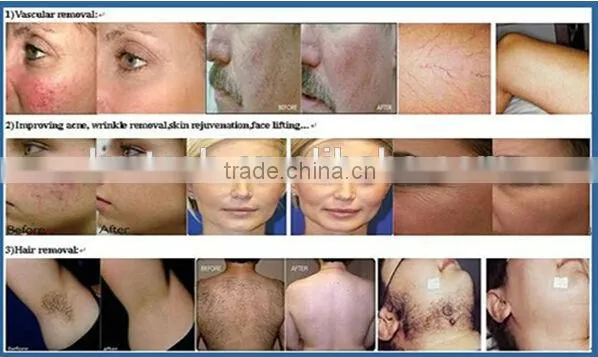 2016 New IPL Nd Yag Laser/SHR laser hair removal tattoo removal 2 in 1 beauty machine