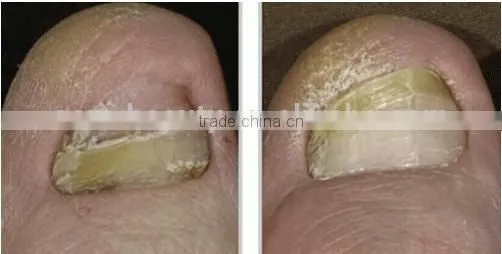 Nd Yag Laser for Varicose Veins/blood Vessel/ hair laser removal machine