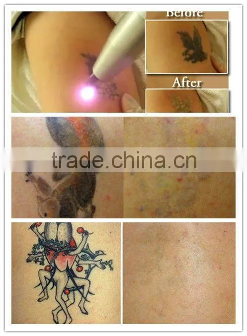 Colour Tattoo Removal Nd Yag Laser