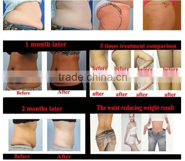 double big handles work at the same time weight loss cryolipolysis-machine-for-home-use