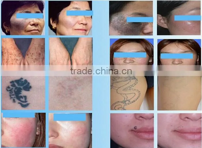 Best quality hot selling tattoo removal machine 1064nm&532nm q switched nd yag laser