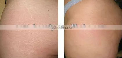 L007 derma roller 1.5 stretch marks, private dermaroller