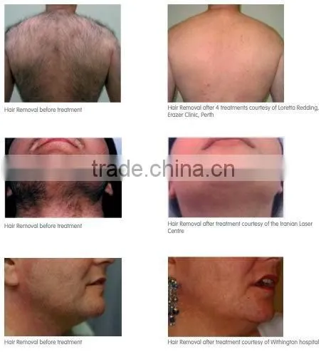 2015 New Arrival 808nm Diode Laser hair removal equipment DL-A1