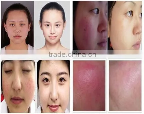 JMSHR hot promotion diode laser vascular removal device for beauty salon use