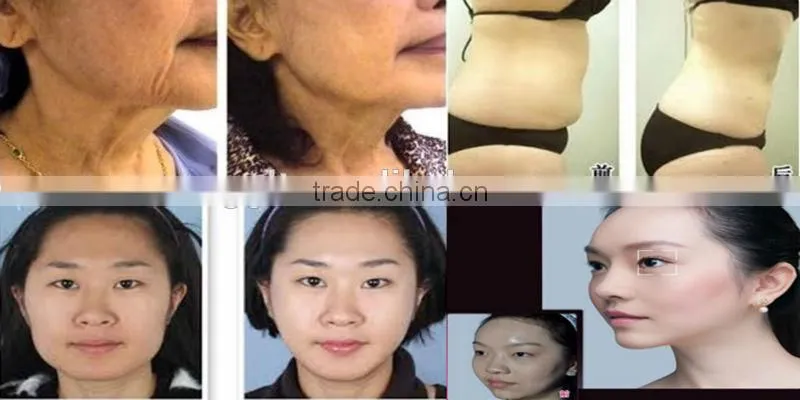 Ipl hair removal NO laser level rf bipolar machine