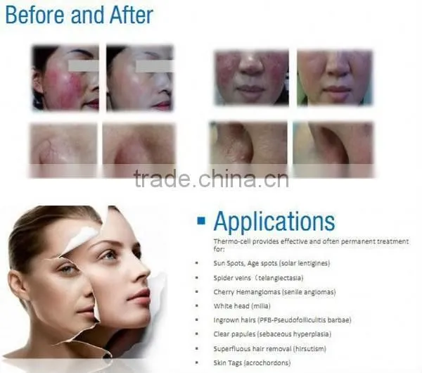 Salon use Acne treatment and Face clean machine RBS