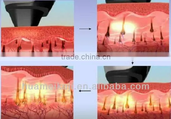 808nm diode laser machine medical intrument