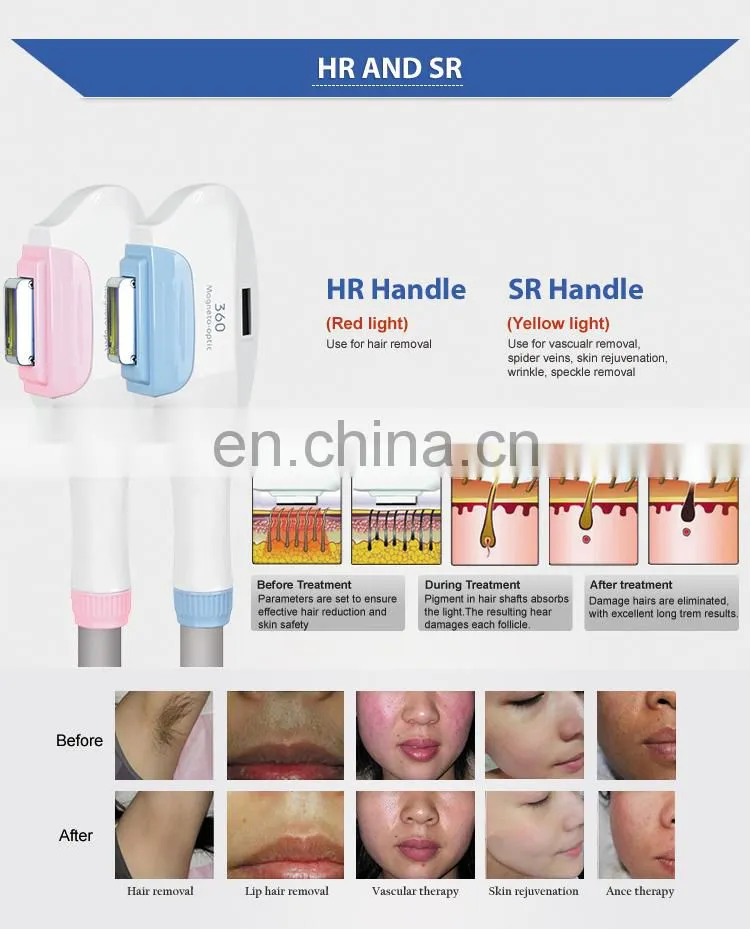 hot sale 360 magneto IPL hair removal skin photo rejuvenation machine