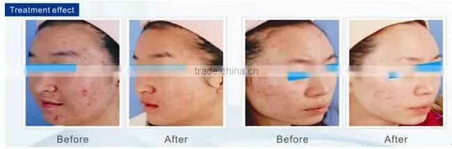 Red Light Blue Light Acne Removal Skin Rejuvenation LED Machine with CE approval