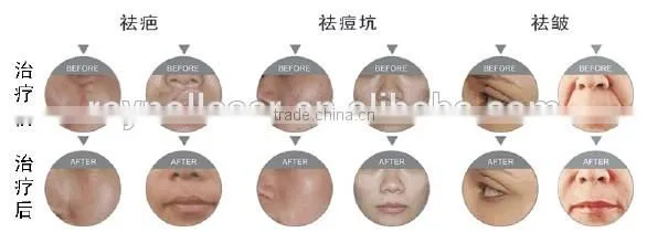 Vaginal Tightening Fractional CO2 Laser Beauty Salon Equipment