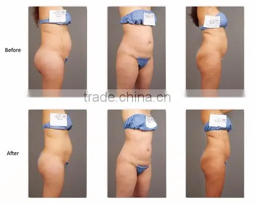Permanent Body Slimming Ultrashape/Best slimming machine Ultrashape/High Quality Ultrashap machine for salon
