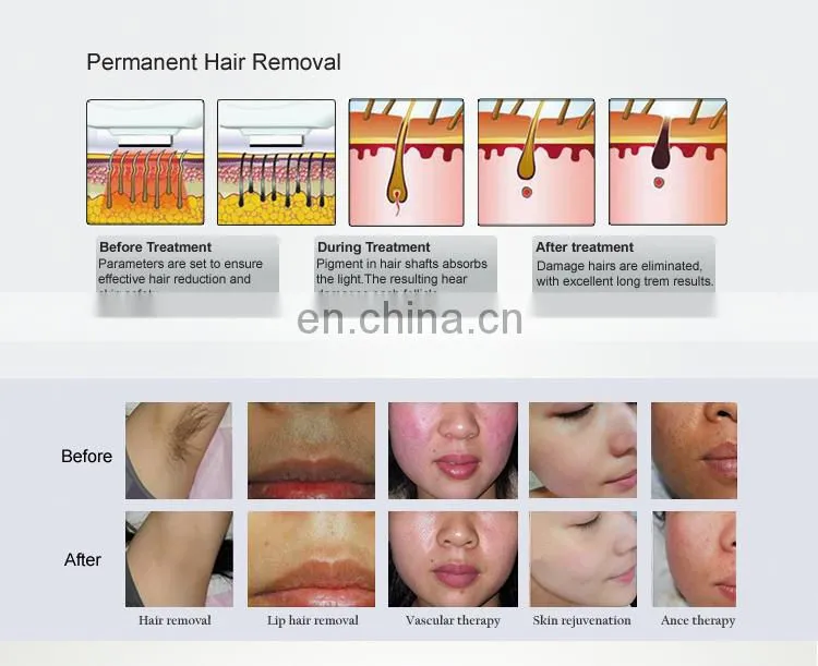 2019 Clinic Use Factory price portable ipl skin rejuvenation & hair removal machine for sale