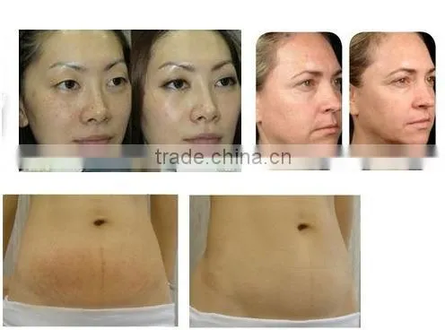 2014 best rf skin tightening face lifting machine/bipolar and monopolar rf