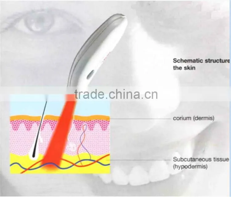 Best effective hot sale soft acne laser removal/acne treatments pen for sale