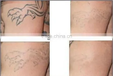 Body care equipment q switch laser tattoo removal equipment
