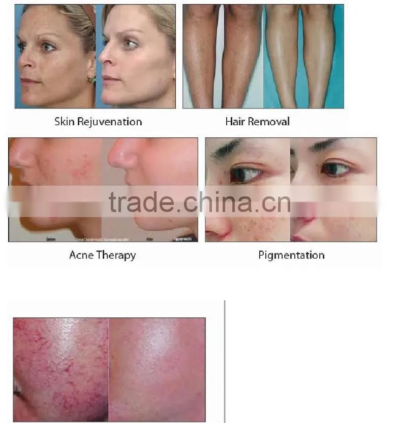 Hot new product ipl intense pulsed light/ipl treatment system