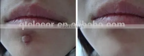 Beijing factory offer new multifunctional q switch nd yag laser beauty machine