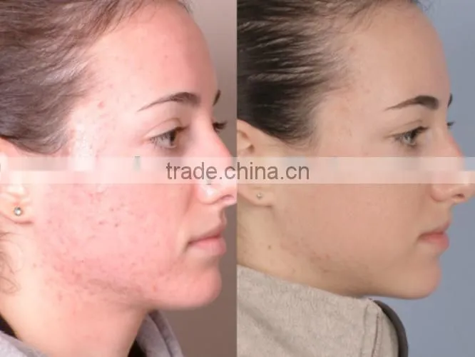 China new Multifunction Bio Oxy Skin jet water oxygene peel