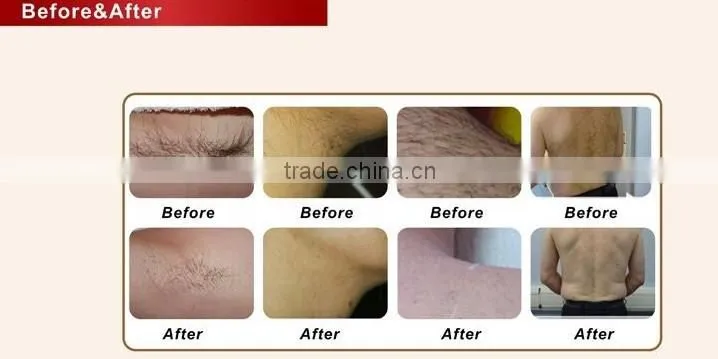 Home Use 808nm diode laser machine for hair removal