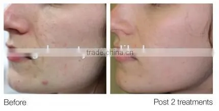 WF-15 Water aqua dermabrasion peeling machine