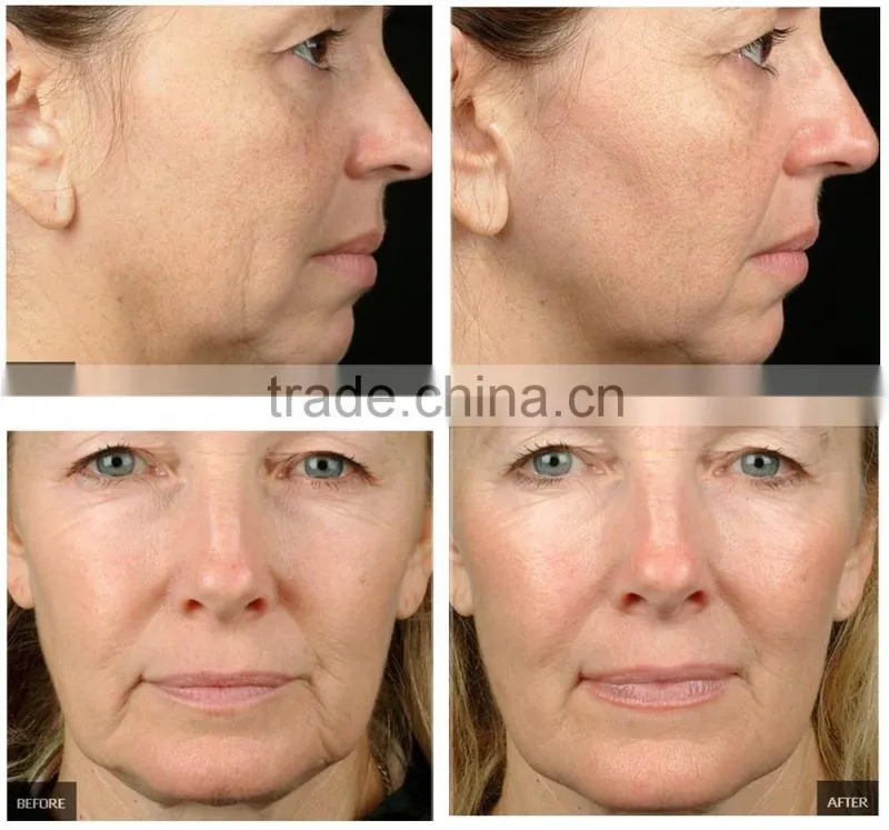 portable skin rejuvenation fractional rf microneedle for skin problems