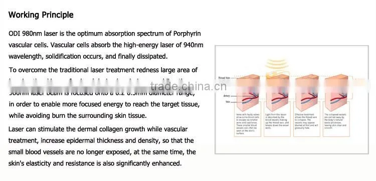 Technology 2016 varicose vein removal 980 vascular therapy machine
