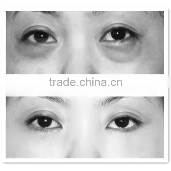 hot selling best effective eye bags removal wrinkle removal beauty machine