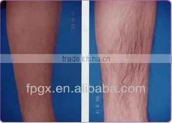 New protable IPL machine