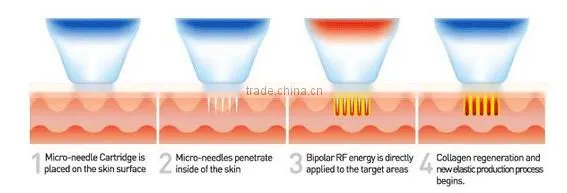 New Hot Invasive Micro Needle Radio Frequency Facial Machine