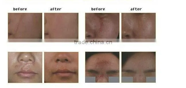medical super pulse Laser co2 fractional equipment for skin beauty scar removal skin rejuvenation clinic use