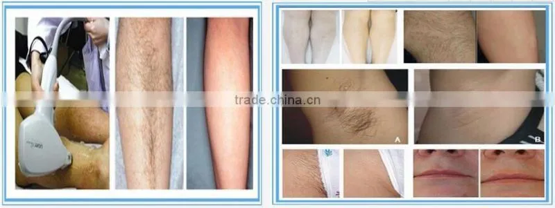 high performance 808 diode laser hair removal equipment for permanent hair removal