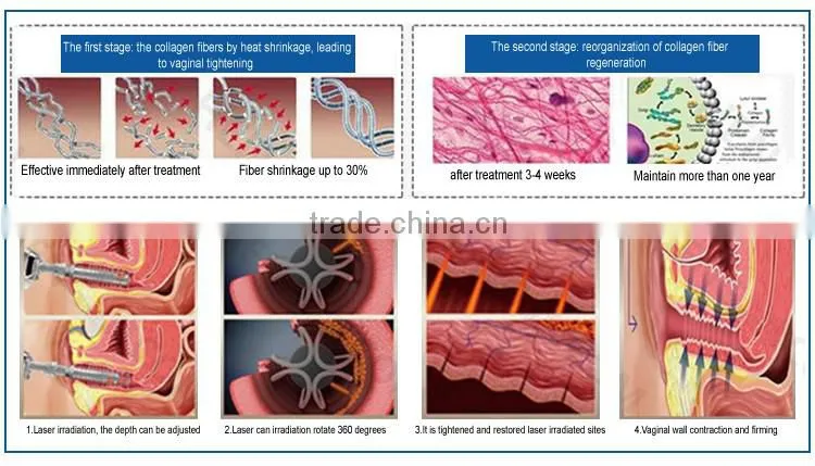 High quality co2 laser vaginal rejuvenation treatment
