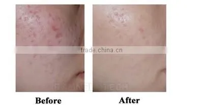 Professional 40W RF Tube Micro Fractional CO2 Laser Medical CE Certification