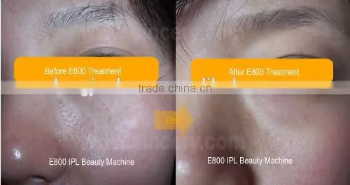 Best choose Beauty Salon Equipment ipl diode laser hair removal machine price
