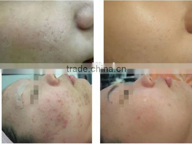 High Quality Distributor Price microneedling maschine/dermapen/derma stamp electric pen