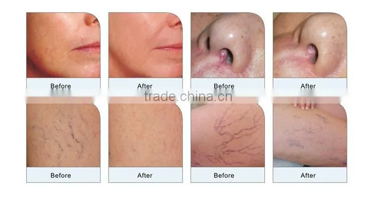2016 Hot seller Professional Ultrapulse Laser Vein Removal Machine/Vascular Spider Veins Removal