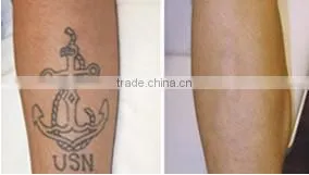 New product in 2015 q switch nd yag laser tattoo removal system q-switched nd yag laser nd yag laser in china