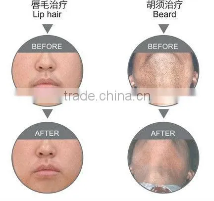 Portable professional IPL hair removal machine distributors wanted